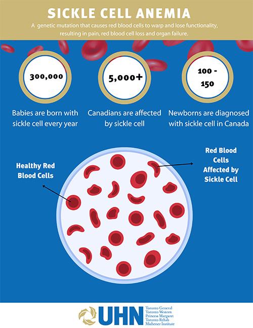 Sickle Cell Anemia graphic showing healthy red blood cells and red blood cells affected by Sickle Cell