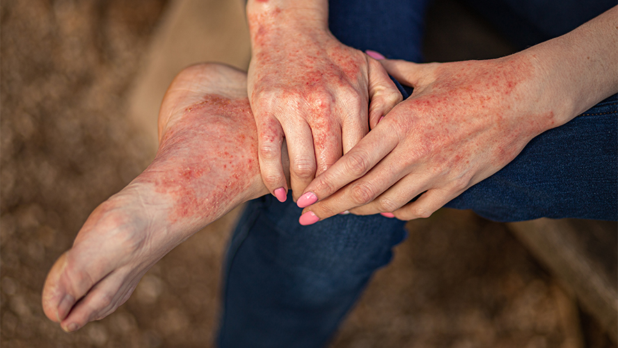 PsA is often associated with psoriasis, a skin condition that is characterized by red, scaly patches; however, not everyone with psoriasis develops PsA. (Getty Images)