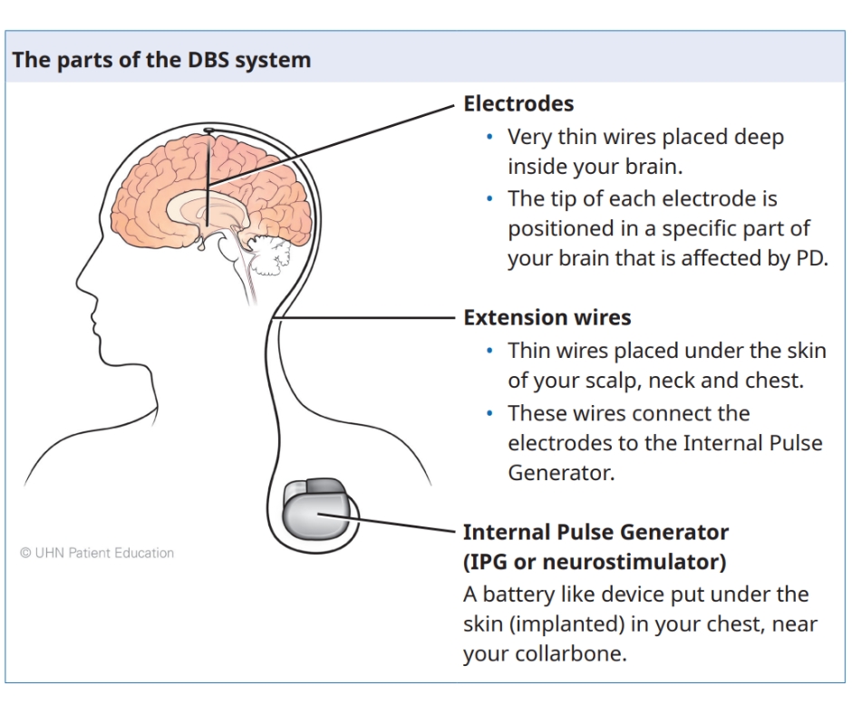 The parts of the DBS system