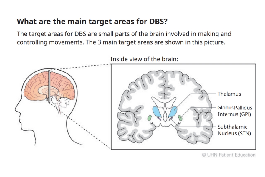 What are the main target areas for DBS?