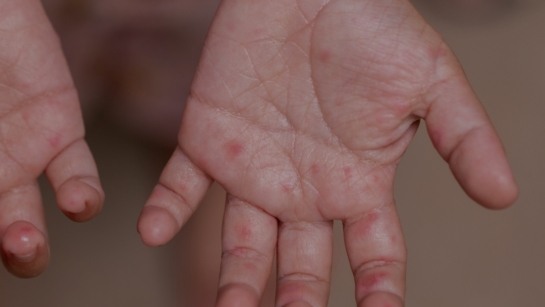 measles on hands