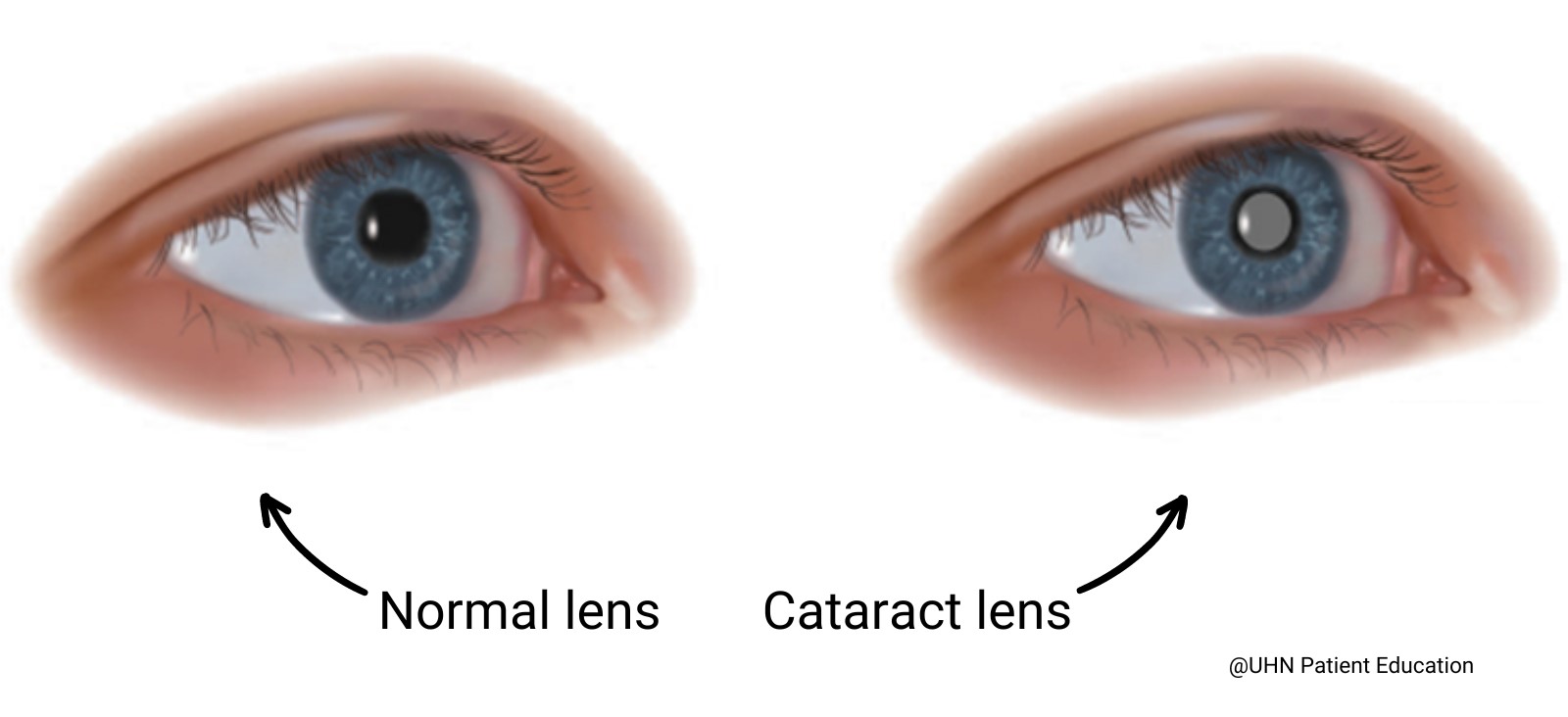 Close-up comparison of two human eyes: one with a normal lens and the other with a cataract lens, labeled "Normal Lens" and "Cataract Lens" respectively. The eye with the normal lens is clear, while the eye with the cataract lens shows a cloudy, milky appearance. Text at the bottom right credits UHN Patient Education.