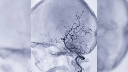 Blood vessels in the brain