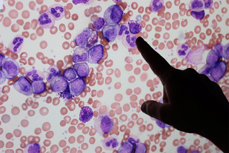 Dr. Rumina Musani, a hematological pathologist at UHN, pointing to a basophil in a digital file of a blood smear, an indicator that a patient has chronic myeloid leukemia. (Photo: UHN)