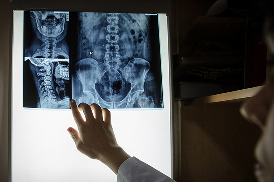 Spine x-ray photo on the wall with a light behind it and with a hand pointing to it.