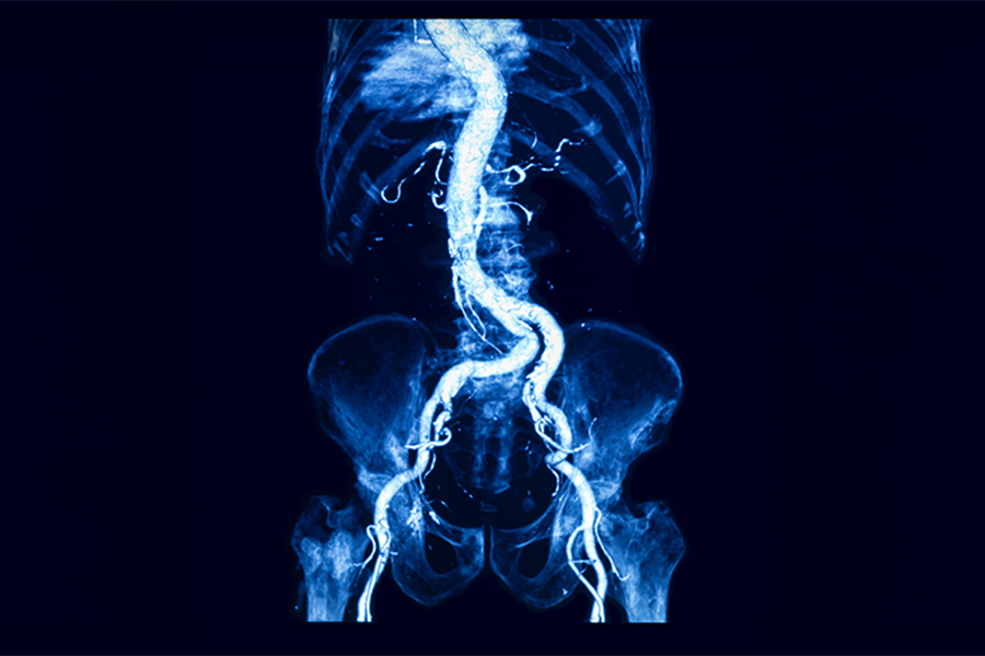 ​​The aorta runs from the heart through the chest and abdomen. In the lower part of this main artery, a bulge — called an aneurysm — can rupture, causing life-threatening bleeding. (Photo: Getty Images)