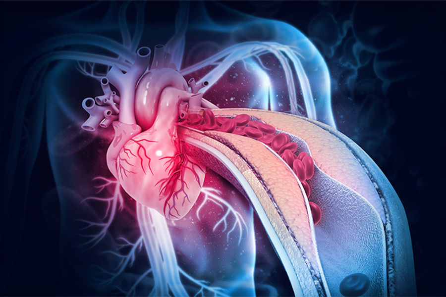 Atherosclerosis is a complex disease in which plaque buildup in artery walls can block blood flow or rupture, causing stroke.
