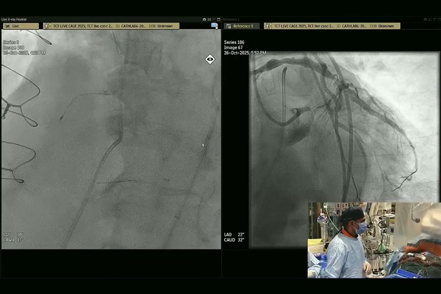 Dr. Sanjog Kalra performed intravascular imaging in complex PCI during his live case session at the 2025 TCT Conference.