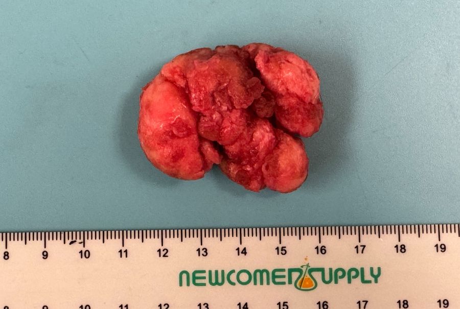 An image of a tumour next to a ruler showing the size between 4 and 5 centimetres. 