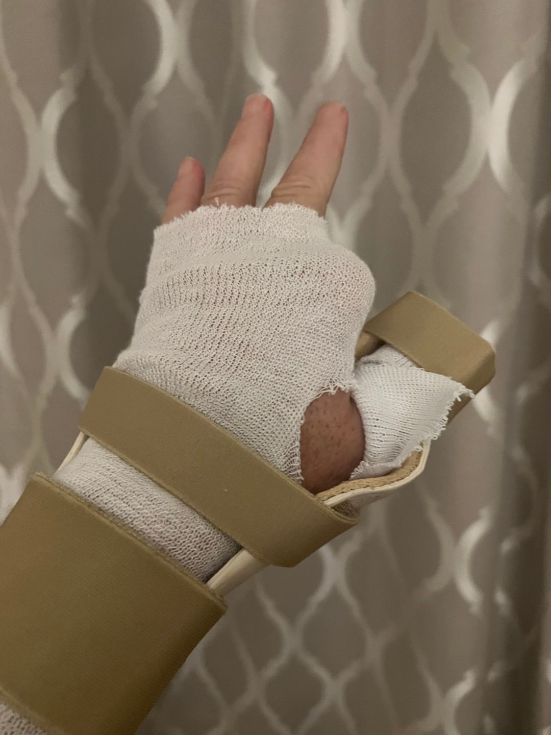 Richard's hand with bandages wrapped around it.